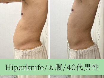 ソルニス(Solnis.)/痩身☆脂肪分解/ハイパーナイフ