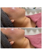 シュガー(Sugar...iyr)/ハーブピーリングとレモンボトル