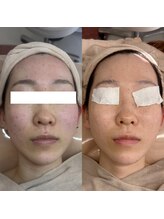 お肌想いラボ/おでこ、両頬の赤み改善