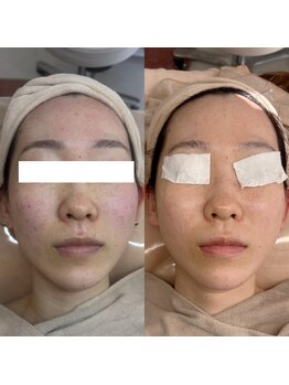 お肌想いラボ/おでこ、両頬の赤み改善