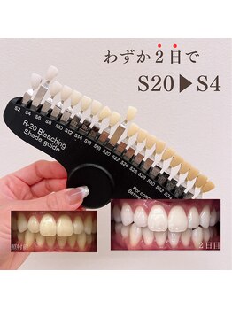 ブリエ(BRILLER)/《医》高効果ホワイトニング症例