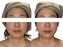 ユニ(Uni)/エラハリもたるみにも！