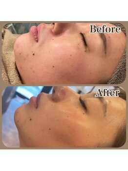 ファビー(Fabby)/☆BBLフェイシャル☆