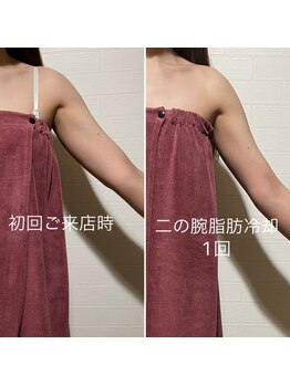 ルーチェエムベルシック(Luce.MBelChic)/二の腕の脂肪冷却