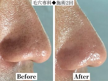 フレイヤ(FREYA)/毛穴専科Before→After