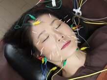 リッチョ鍼灸院(Riccio鍼灸院)/微電気を流し筋肉を緩めます