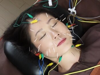 リッチョ鍼灸院(Riccio鍼灸院)/微電気を流し筋肉を緩めます