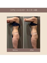 エクラ(ECLAT)/コアヒート痩身