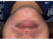 ベルフィオーレ(bel fiore)/30代男性　7回目 After