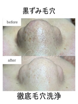 アルルプラス 山科(ARuru+)/毛穴悩みに☆