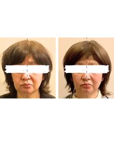 ビーサロン(B-salon)/たるみ/小顔コルギ+テラボーラー