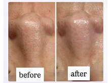 ユズドット(yuzu.)の雰囲気（毛穴洗浄＋生ビタミンC導入★毛穴形状記憶をリセット!!）