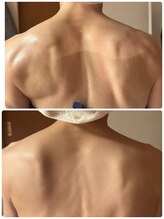 ジフィー(Gify)/筋膜リリースカッターTotal 4回