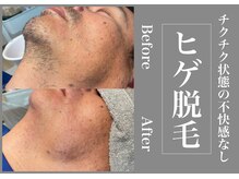 さくら通りクリニック/チクチク状態の不快感なし！
