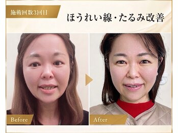 サロンチオリ 烏丸(Salon Chiori)の写真/40代50代の深いほうれい線・頬下がりへ。顔を丁寧に施術＋身体から整える本格たるみ改善