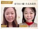サロンチオリ 烏丸(Salon Chiori)の写真/40代50代の深いほうれい線・頬下がりへ。顔を丁寧に施術＋身体から整える本格たるみ改善