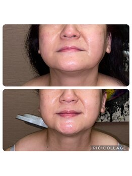 ビユ 大泉店(BIYU)/美肌小顔リフトアップ