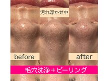 レアマカナ(LeaMakana)/毛穴洗浄＋ピーリング