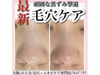 アルムダアクア 天王寺店(Aleumda AQUA)/毛穴エクストラクションプロ大阪