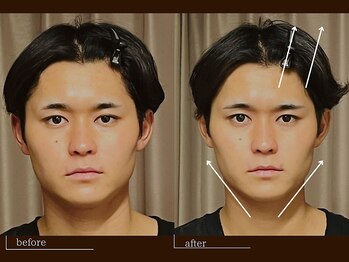 クレスト(CREST)/ビフォーアフター【小顔名古屋】