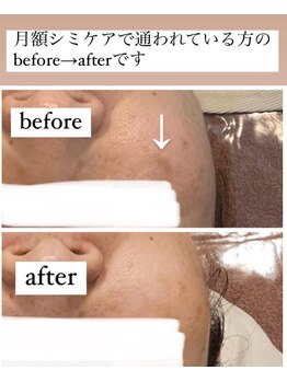 メリーオーシャンズ(merry ocean’s)/シミケア＋毛穴洗浄　５回目症例