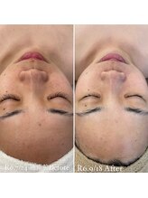 ミエル 神戸店(Miel)/リアボーテで肌質改善！