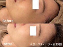 サロンヴェアリー 広尾(salon vary)/赤みの鎮静！透明感up#白玉#水玉