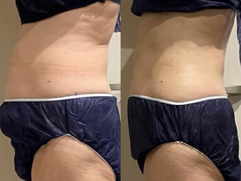 キララ(Kirara)/寝てるだけサイズダウン