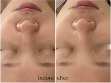 ステラ(Stella)/30代施術症例