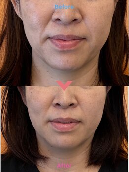 パーチェスガールズ 姪浜店(Pace-se Girls)/小顔矯正