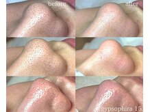 ジプソフィラフィフティドット(gypsophira15.)の雰囲気（すべて1回の変化です。黒ずみ毛穴諦めてませんか？）