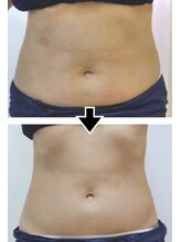 ホッコリ 段原店(HOKKORI)/寝たまま痩身ダイエット