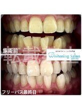 ホワイトニングサロン 福岡天神店/ホワイトニング