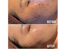 キセキ(KISEKI)/肌荒れ改善