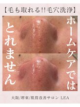 レア(Lea)/ホームケアでは改善しません><