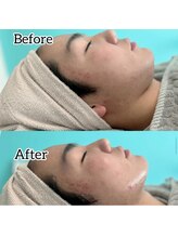 キノ(Kino)/レモンボトル痩身美容液導入★