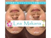 レアマカナ(LeaMakana)/毛穴洗浄＋光＋炭酸パック