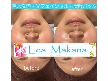 レアマカナ(LeaMakana)/毛穴洗浄+光+炭酸パック