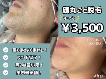 ミミロンビューティー(Mimiron Beauty)の写真/【福岡/井尻駅徒歩30秒】毎日のヒゲ剃り・肌荒れのお悩み!施術時間最短10分で終了!仕事の間にもOK!