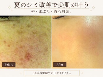 サロンドエステケイワイ(de KY)の写真/見てわかる!【濃いシミ改善】施術後黒ずみを確認!痛みが少ない最新の専用機器による丁寧施術◎高技術◎