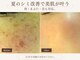 サロンドエステケイワイ(de KY)の写真/見てわかる!【濃いシミ改善】施術後黒ずみを確認!痛みが少ない最新の専用機器による丁寧施術◎高技術◎