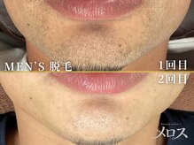 メロス 金沢店の雰囲気（ヒゲ脱毛も2回目で青ひげが減り、スッキリとした印象に！）