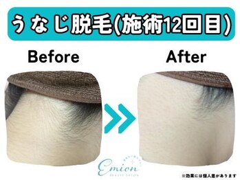 エミオン(Emion)/《うなじ脱毛 Before→After》