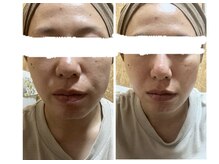 リンカ(Rinca)/光フェイシャルで内側から綺麗に