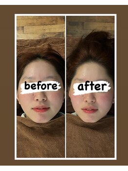 みずわき治療院/ハイパーナイフでスッキリ小顔♪