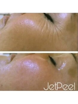 リラクゼーションアンドビューティーボヌール(BONHENR)/JETPEELの効果