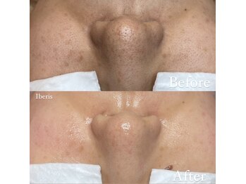 イベリス(Iberis)/ハーブピーリング/毛穴