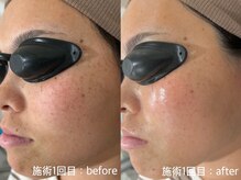 ルーメ(LUME)の雰囲気（IPL光フォト！シミ・しわ・たるみケア！1回でハリ・ツヤ実感！）