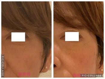 小顔コルギ専門店 フェルーシュ 成田駅前店(Feruche)/サーモシェイプ結果写真