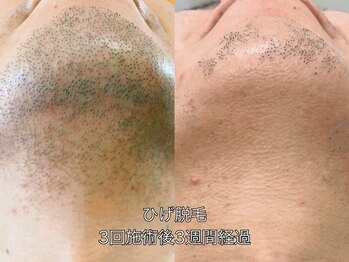 エクレ 柏店(EKURE)/ヒゲ脱毛